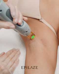 “Alexandrite lazer KKTC – Epilaze Laser Studio’da Alexandrite epilasyon işlemi uygulanan kadın”